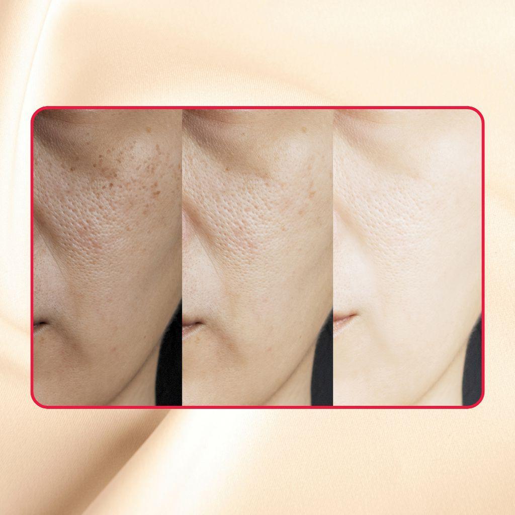 Glycolic + Lactic Acid Resurfacing Peel